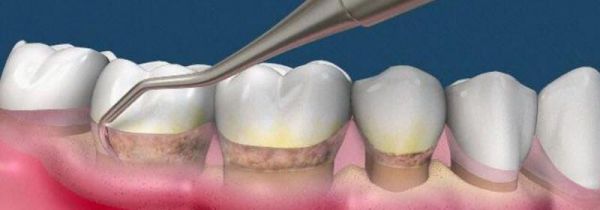 洁牙后注意事项有哪些