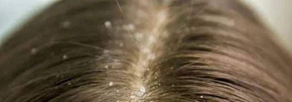 头皮屑太多是什么原因