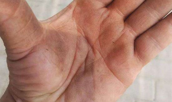 吃核桃手黑怎么洗掉