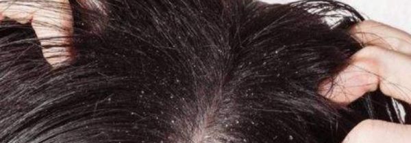 头皮除螨的方法