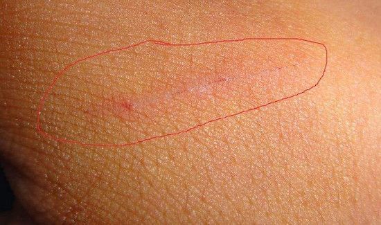 12个急救小技巧