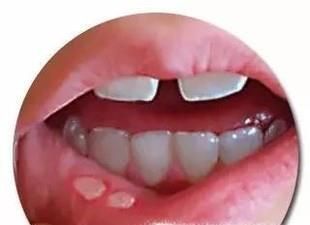 吃滚烫的食物会有哪些危害