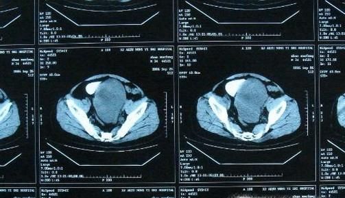 大病医疗保险怎么报销