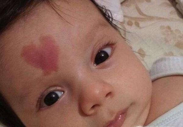 胎记能彻底清除吗？