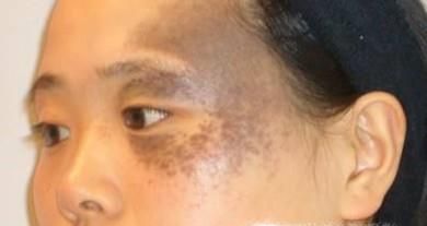 胎记能彻底清除吗？