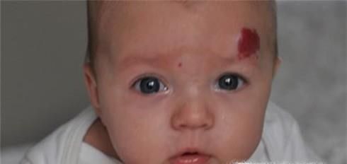 胎记能彻底清除吗？