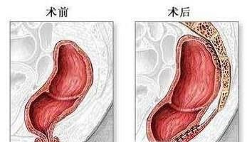便秘引起脱肛怎么办