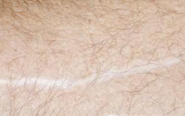 受伤后怎样不留疤