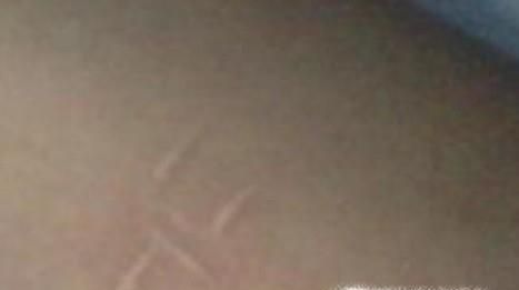 受伤后怎样不留疤