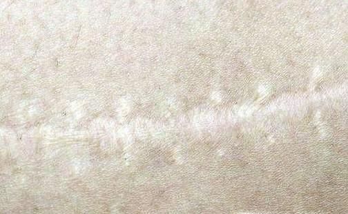 受伤后怎样不留疤