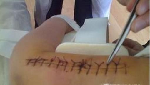 频繁换药不利于伤口愈合？