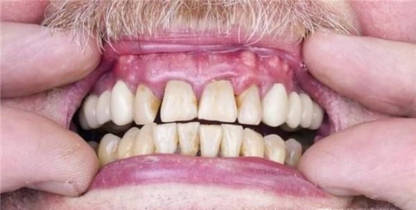 不刷牙给我们带来的坏处