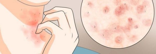 皮肤碰到衣服就特别刺痛