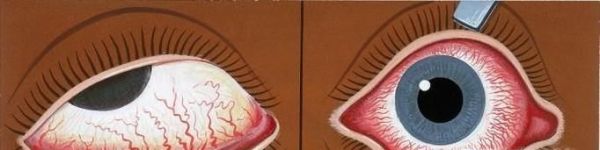 熬夜玩手机对眼睛的危害