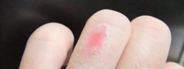 被烫伤可以用牙膏吗