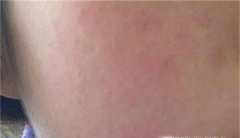 长期使用化妆品有哪些危害