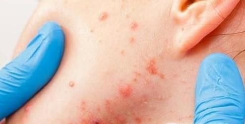 长期使用化妆品有哪些危害