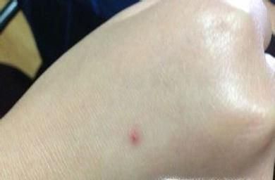 夏季如何避免蚊子的叮咬？