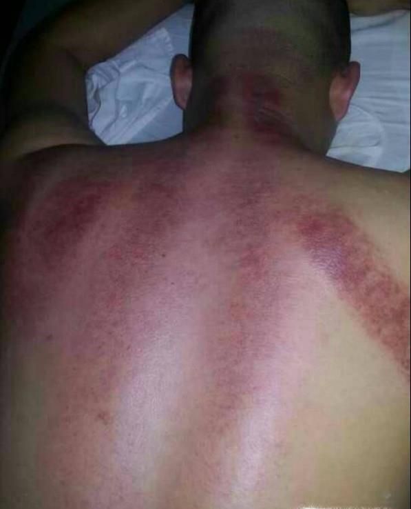 刮痧的好处有哪些