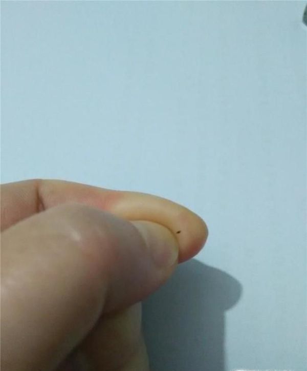 怎么去肉刺，肉里扎进刺怎么办