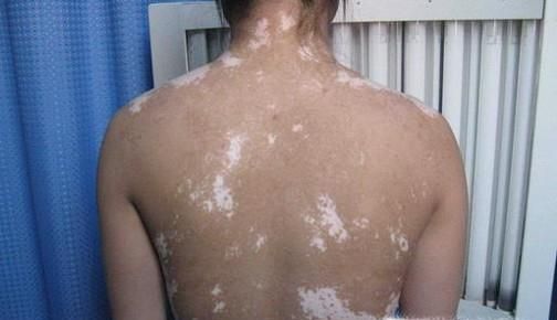 藿香正气水有哪些意想不到的妙用?