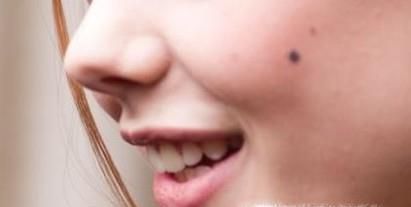 点痣后的注意事项有哪些?