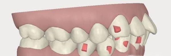 怎样看自己是不是龅牙
