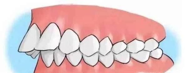 怎样看自己是不是龅牙