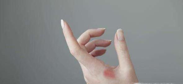 被烫伤之后应该怎么办？