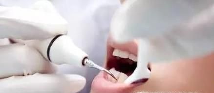 洗牙对牙有伤害吗