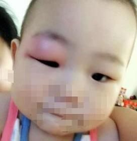 宝宝眼睛被蚊子咬肿了怎么办