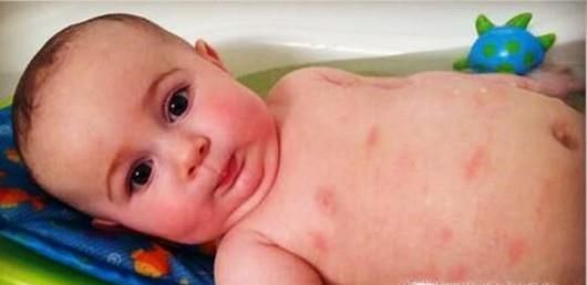 儿童登革热有哪些症状？儿童如何预防登革热？