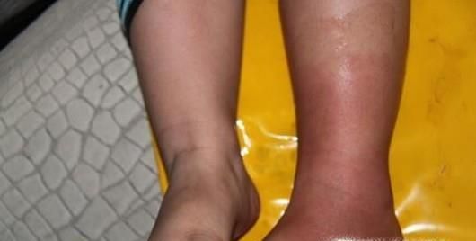 儿童登革热有哪些症状？儿童如何预防登革热？