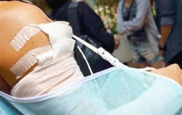 伤残鉴定的最佳时间