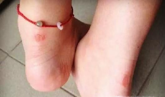 夏季如何健康穿高跟鞋？这样做远离足蜂窝织炎！