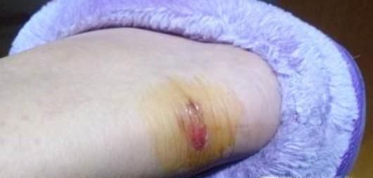 夏季如何健康穿高跟鞋？这样做远离足蜂窝织炎！