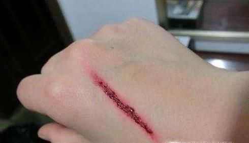 蛾蚋幼虫进入人体怎么办