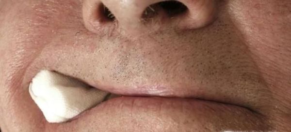 拔牙之后需要注意些什么？