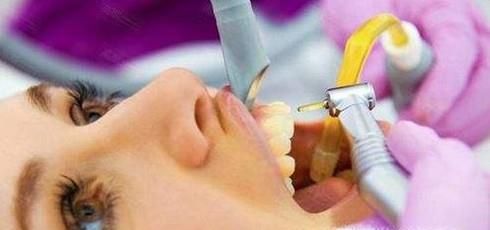 洗牙有什么认识误区？洗牙有什么好处？