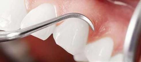 洗牙有什么认识误区？洗牙有什么好处？