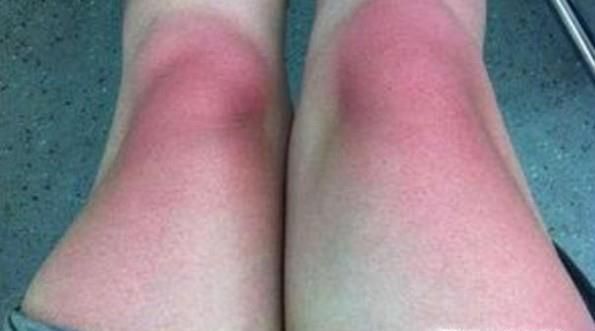 为什么有些人的皮肤晒黑之后不容易变白？