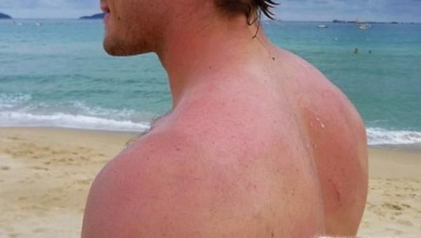 为什么有些人的皮肤晒黑之后不容易变白？