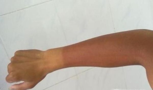 为什么有些人的皮肤晒黑之后不容易变白？