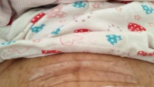 剖腹产所存在的误区有哪些呢？