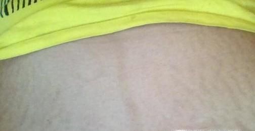 剖腹产所存在的误区有哪些呢？