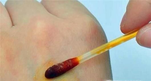 被蜱虫叮咬后怎么办？夏季如何防止被蜱虫叮咬？