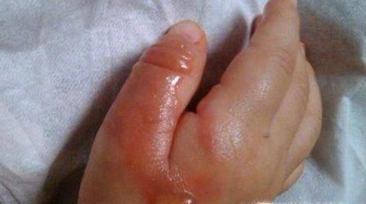 孩子夏季烫伤之后如何正确处理？