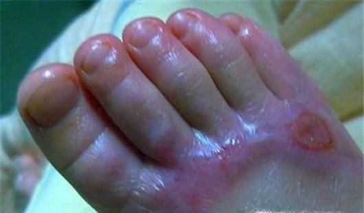 孩子夏季烫伤之后如何正确处理？