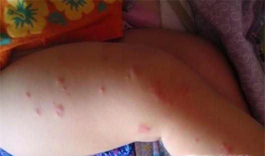 被螨虫咬了有什么症状？夏季如何预防螨虫？