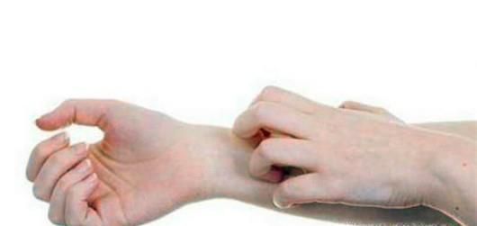 被螨虫咬了有什么症状？夏季如何预防螨虫？